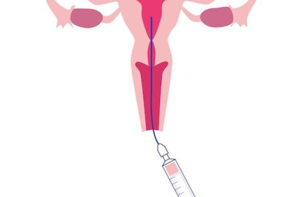 Methods of intrauterine insemination (IUI)